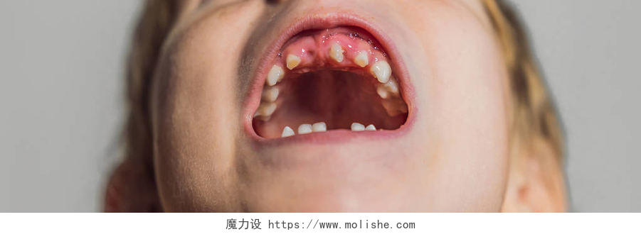 不正常的男孩牙齿牙齿矫正修复口腔牙齿口腔牙齿